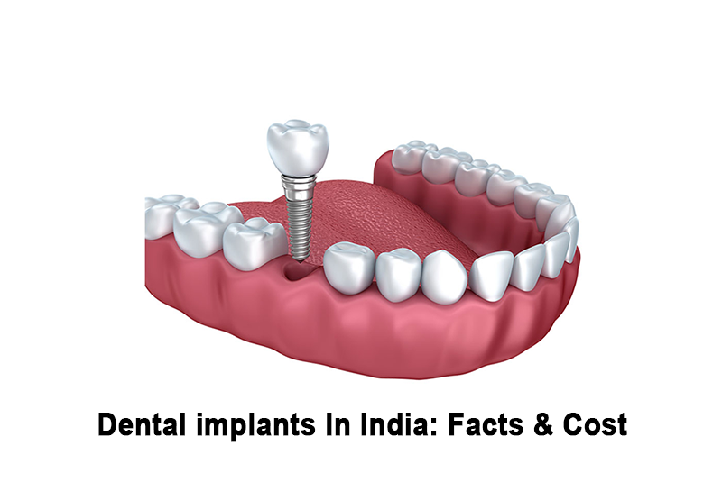 Dental implant cost in India