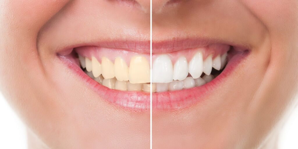 Teeth Whitening