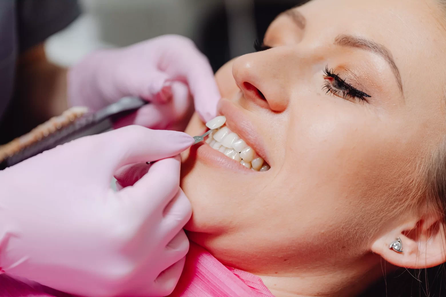 Dental-Veneers-Texla-Dental-Blog-Cover