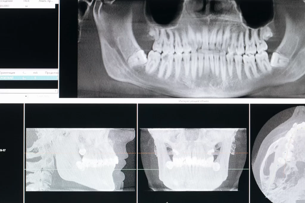OPG Dental X-Ray Full Form Uses, Procedure and Safety