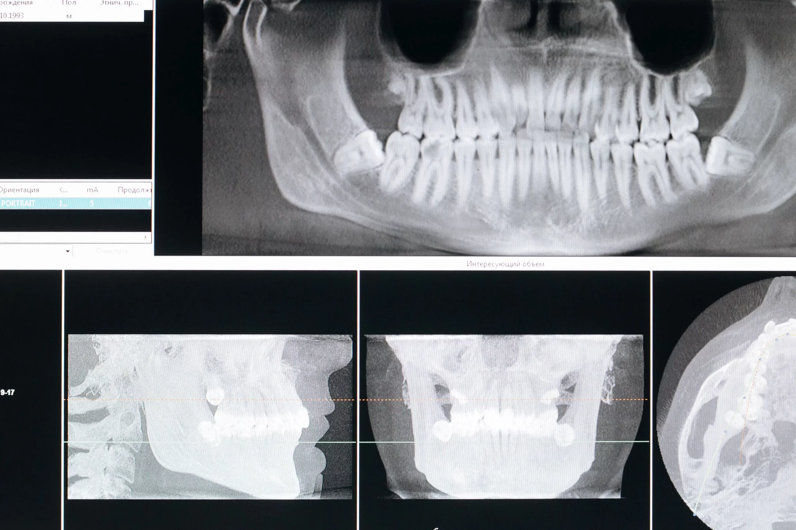 OPG Dental X-Ray Full Form Uses, Procedure and Safety